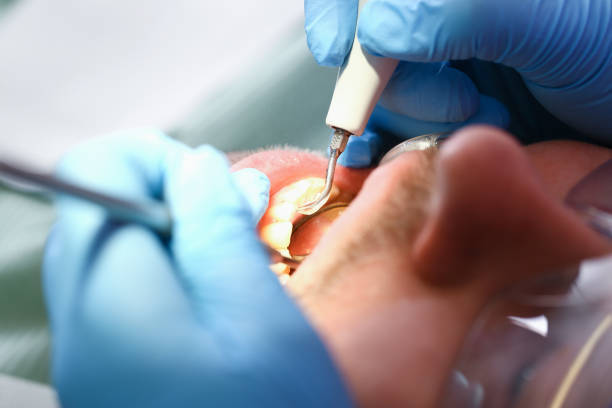 Best Emergency Wisdom Teeth Removal in Kempner, TX