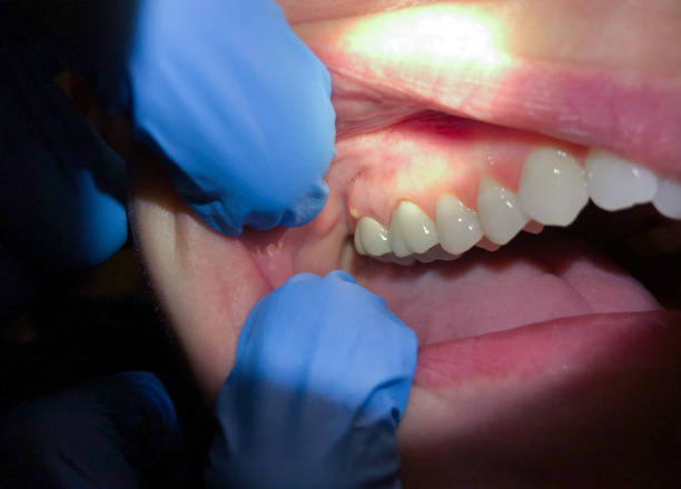 Best Emergency Tooth Extraction in Kempner, TX